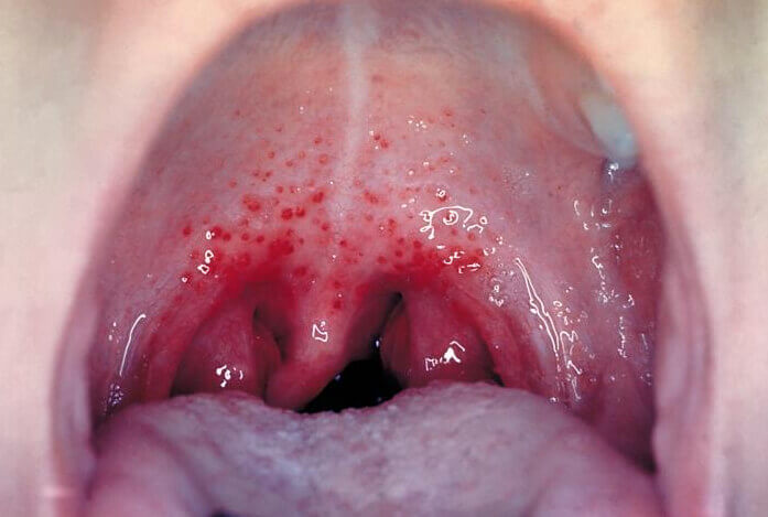 Image result for gonorrhoea